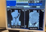 Ảnh chụp CT dạ dày phình to như quả bóng nước của 